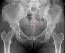 Mirena IUD visible on pelvic radiograph. Mirena IUD - Roe Becken ap.jpg