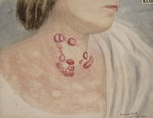 Figure 1. Mycosis fungoides, a skin disease showing nodules and plaques composed of lymphocytes spread across the skin, has been associated with HTLV-II infection Neck of a woman suffering from mycosis fungoides of the skin Wellcome L0061976.jpg