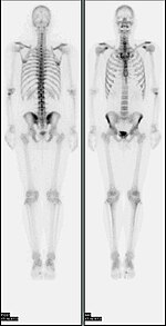 Nl bone scan2.jpg