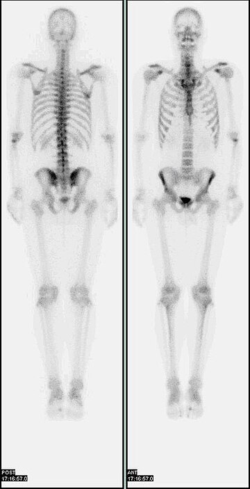 Bone scintigraphy