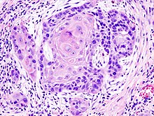 Biopsy of a highly differentiated squamous-cell carcinoma of the mouth. Typical squamous-cell carcinoma cells are large with abundant eosinophilic cytoplasm and large, often vesicular, nuclei. Haematoxylin & eosin stain Oral cancer (1) squamous cell carcinoma histopathology.jpg