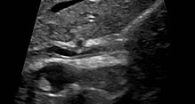 Ultrasound of sclerosing cholangitis in the common bile duct Sclerosing cholangitis 0001.jpg