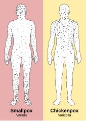 Smallpox and chickenpox virus rash distribution Smallpox versus chickenpox english plain.svg