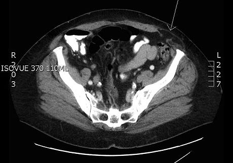 Spigelian hernia