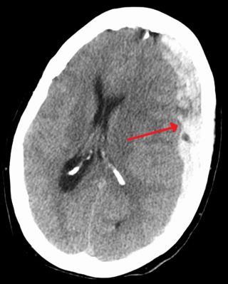 <span class="mw-page-title-main">Subdural hematoma</span> Hematoma usually associated with traumatic brain injury