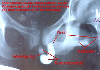 <span class="mw-page-title-main">Retrograde urethrogram</span> Medical imaging of the urethra