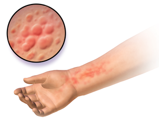 <span class="mw-page-title-main">Autoimmune urticaria</span> Autoimmune disease causing hives and itching