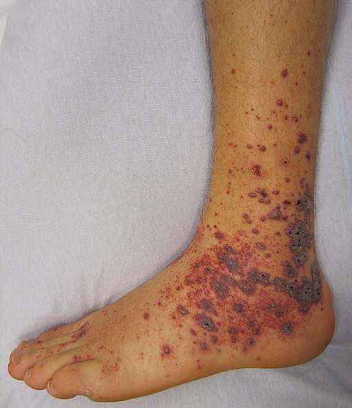 Vasculitis