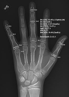 X-ray of a hand with automatic bone age calculation.jpg