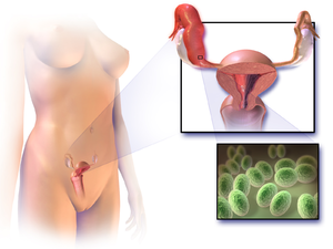 Pelvic Inflammatory Disease