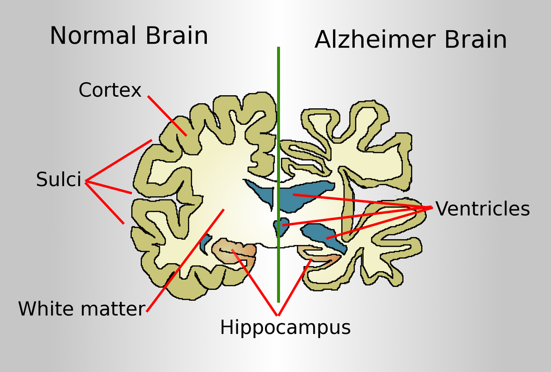 Penyakit Alzheimer