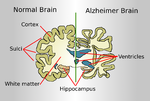 Lakaran kecil untuk Penyakit Alzheimer