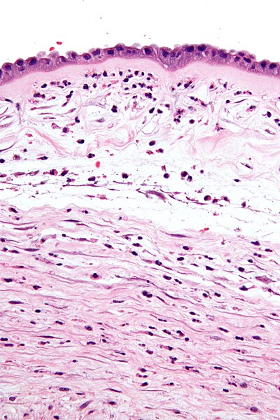 File:Chorioamnionitis - very high mag.jpg