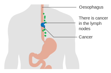 File:Diagram showing oesophageal cancer in the lymph nodes (N staging) CRUK 174.svg