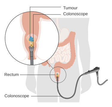 File:Diagram showing trans anal endoscopic microsurgery for early stage rectal cancer CRUK 377.svg