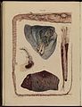 Gangrene, plate III, Robert Carswell 1830s Wellcome L0074378.jpg