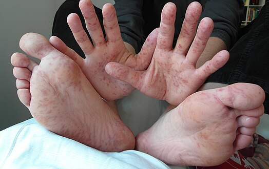 Rash on hand and feet of a 36-year-old man
