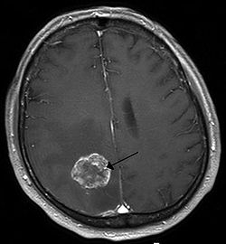 انبثاث الورم الدماغي في نصف الكرة الدماغية الأيمن بسبب سرطان الرئة يظهر بالتصوير بالرنين المغناطيسي الموزون بT1 مع التباين داخل الوريد.