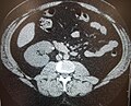CT břicha bez kontrastní látky zobrazující pravý proximální močový kámen způsobující obstrukci a hydronefrozitu.