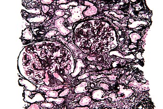 Micrograph of a kidney biopsy stained with a Jones stain. Membranous nephropathy - mpas - high mag.jpg