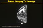 Thumbnail for Breast MRI