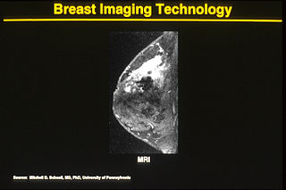 <span class="mw-page-title-main">Breast MRI</span> Form of breast imaging