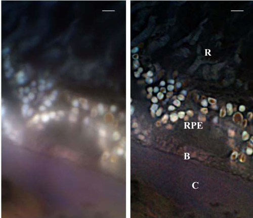 Super resolution microscopic investigation of human eye tissue affected by AMD