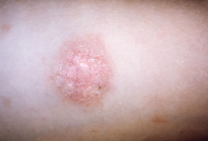 File:Pityriasis rosea.JPG