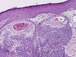 Hidradenocarcinoma