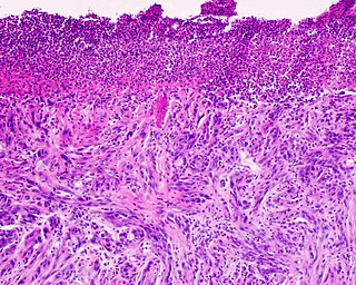 <span class="mw-page-title-main">Desmoplastic melanoma</span> Medical condition