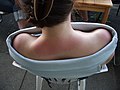 Sunburnt neck and shoulders.jpg