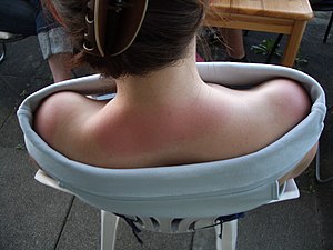 Coup De Soleil: Prévention, Traitements, Sunburn art