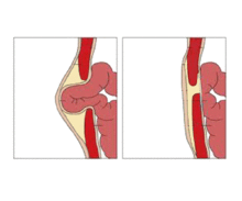 Umbilical hernia: MedlinePlus Medical Encyclopedia Image