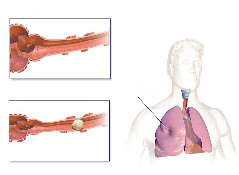 File:Atelectasis Normal vs Affected Airway.jpg