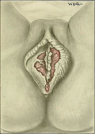 <span class="mw-page-title-main">Esthiomene</span> Medical condition