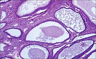 Histopathology of complex hyperplasia without atypia: Cystically dilated endometrial glands lined by a single layer of columnar epithelium. Histopathology of complex hyperplasia without atypia.jpg