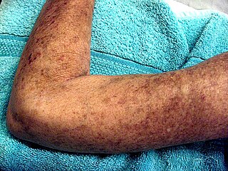 Left Arm Scleroderma Patient.jpg