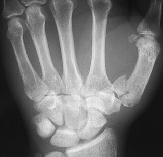 Rolando fracture Medical condition