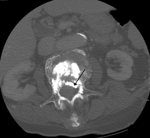 A CT image of cement used in kyphoplasty that has entered the spinal channel and is pressing on the spinal cord resulting in neurological symptoms VertcementCT2.png