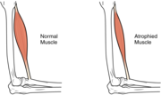 Miniatura para Atrofia muscular