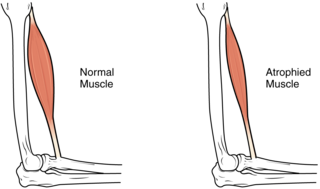 Atrofia Muscular: Etiología, Fisiopatología, Tratamiento potencial