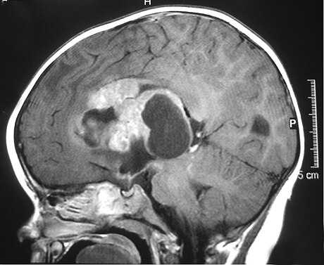 Atypical teratoid rhabdoid tumor