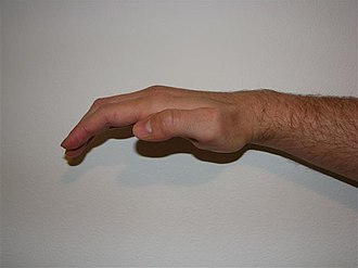 Ape Hand Deformity Apehand 2.JPG