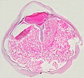 Odchlípení sítnice – histologie