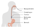 Internal radiotherapy for esophageal cancer