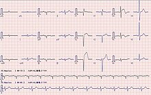 ECG : AMI with ST elevation in V2-4 ECG V2-4 ST change.jpg