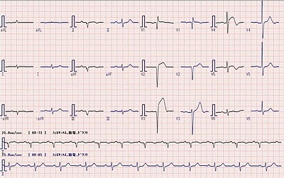 心電図 Wikiwand