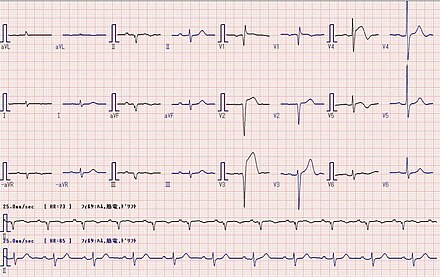 ECG : AMI with ST elevation in V2-4