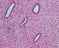 Micrographie d'endomètre décidualisé en raison de progestérone exogène. Coloration HE.