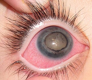 Coats disease Human eye disease causing full or partial blindness